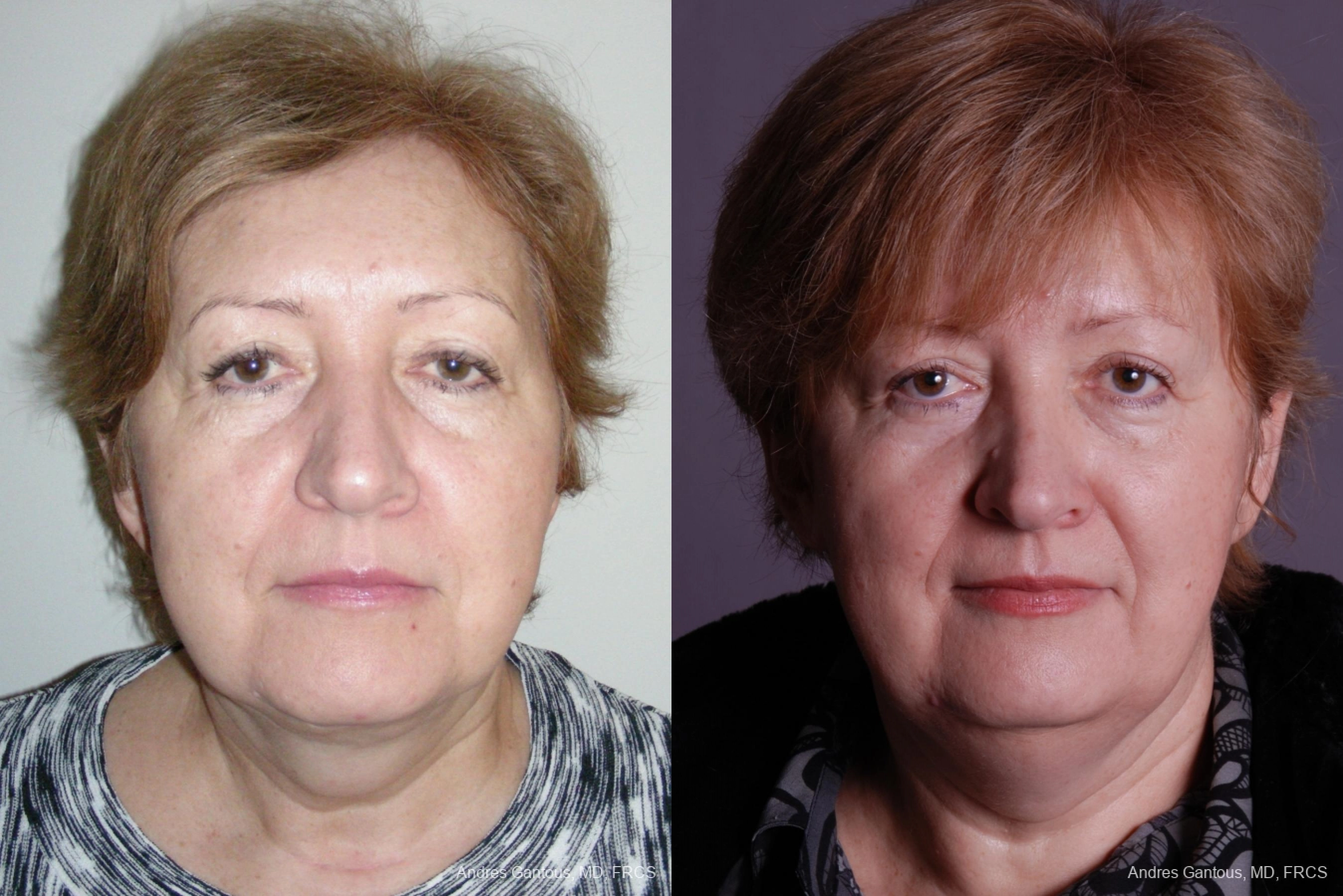 Before and after procedure result