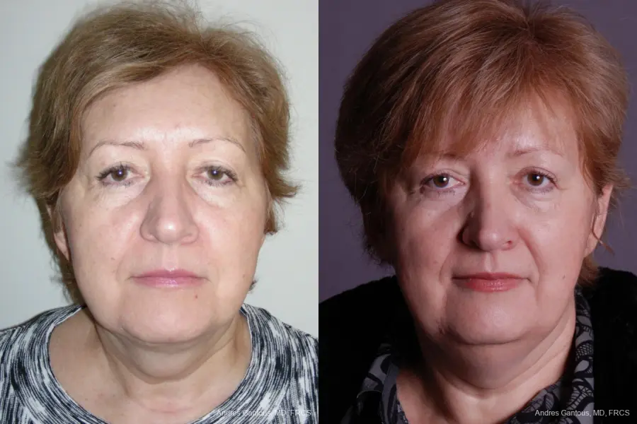 Facelift & Neck Lift: Patient 9 - Before and After 1
