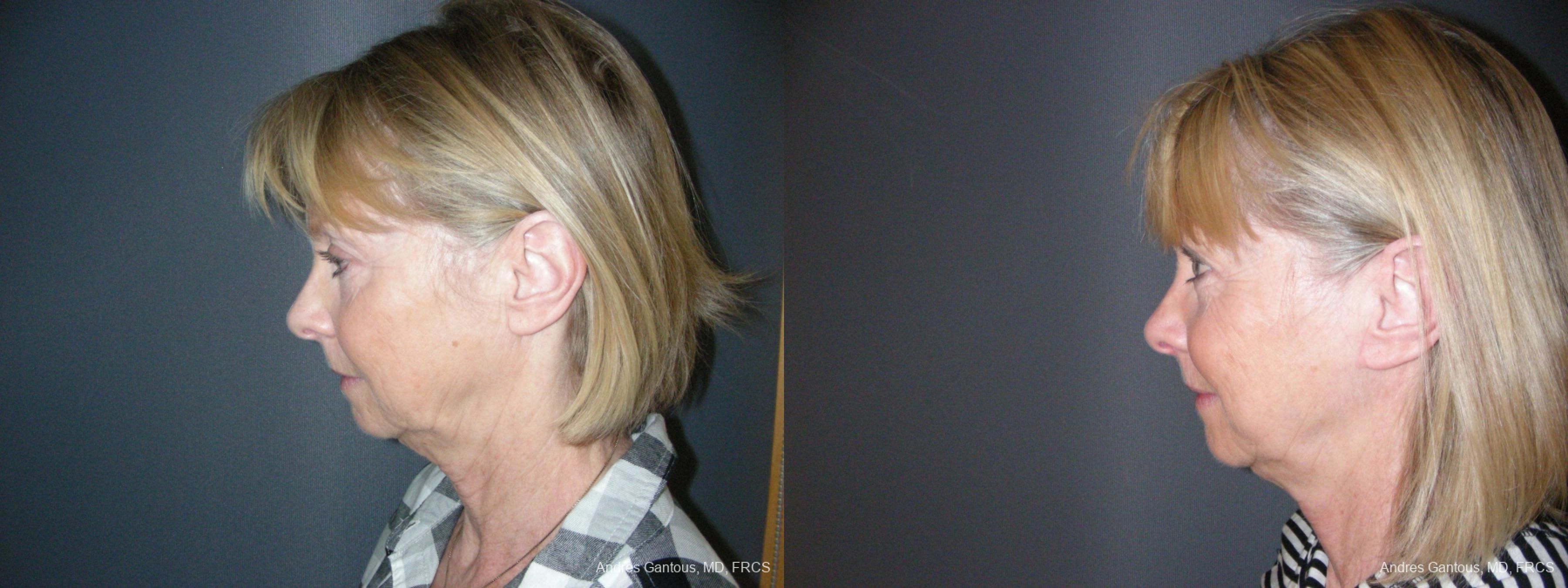 Facelift & Neck Lift - Thumbnail 5