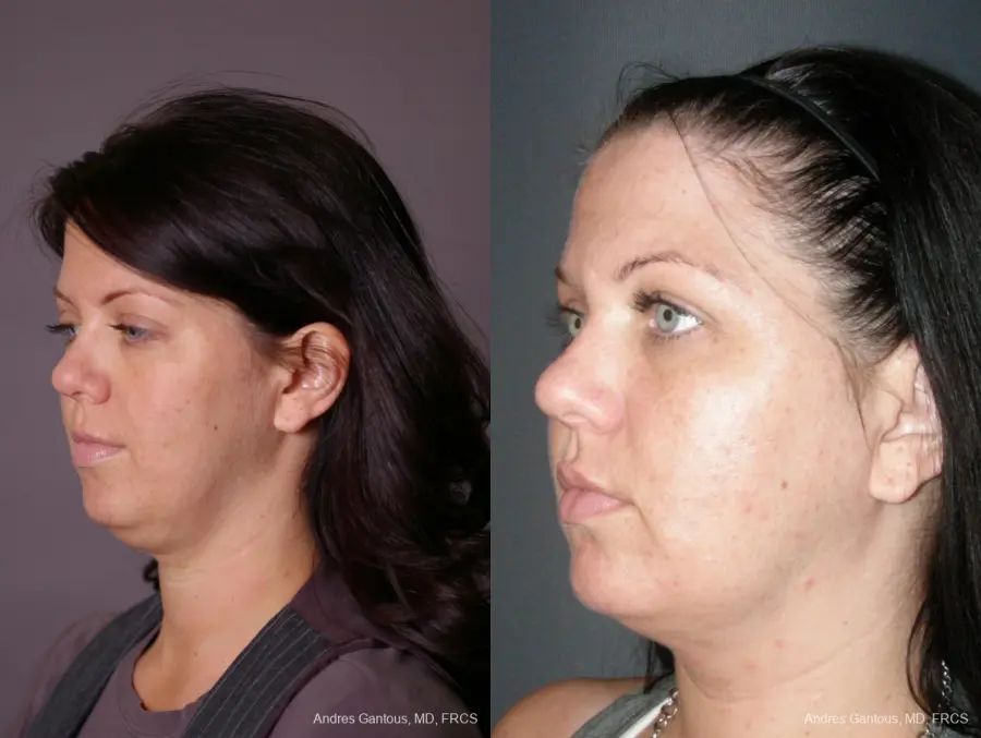 Facelift & Neck Lift: Patient 11 - Before and After 4