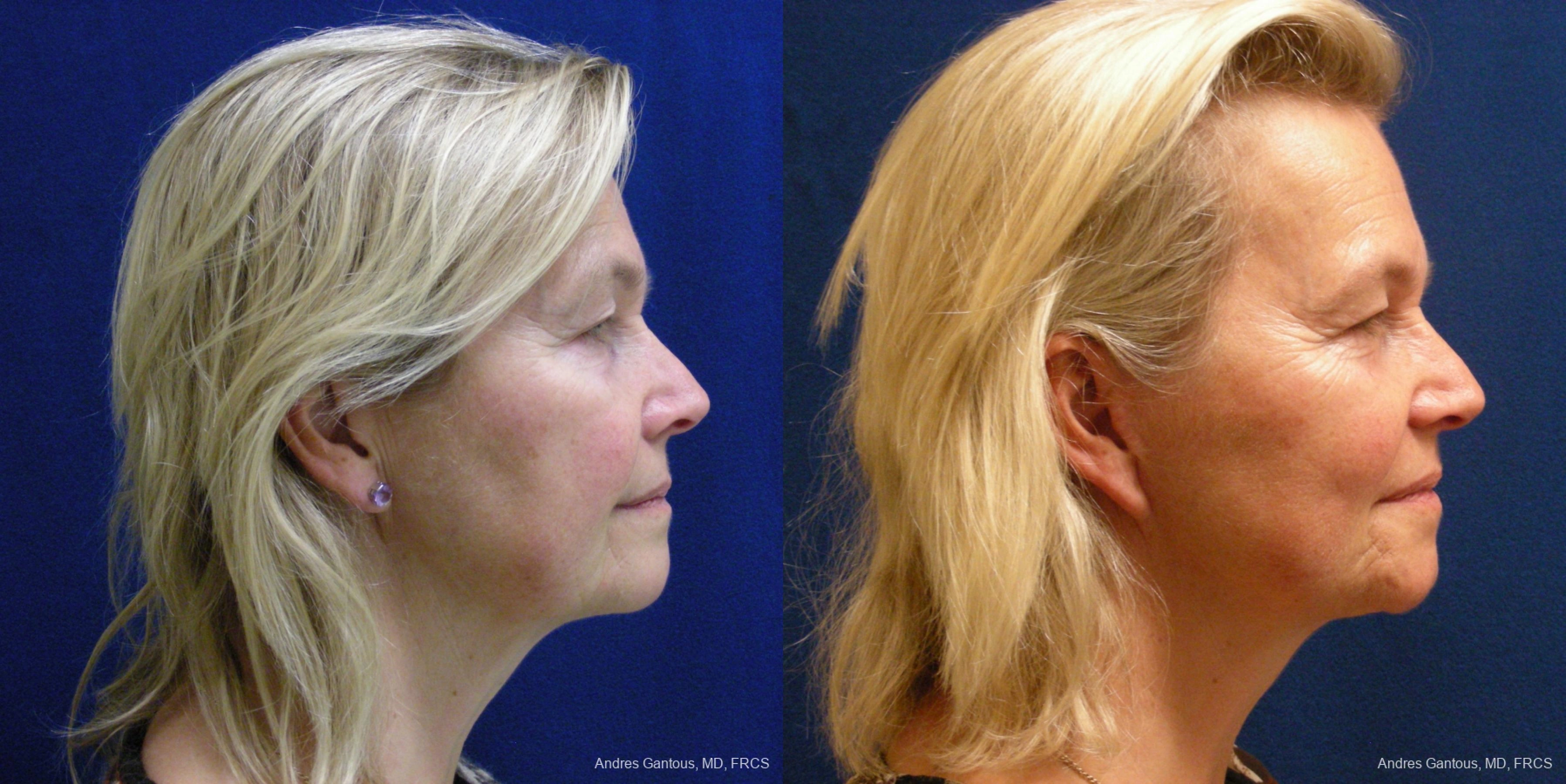 Facelift & Neck Lift - Thumbnail 3