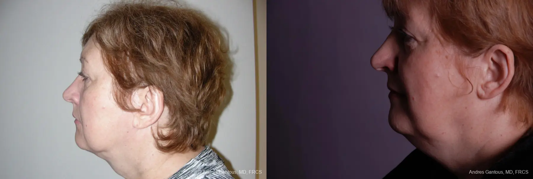 Facelift & Neck Lift: Patient 9 - Before and After 5
