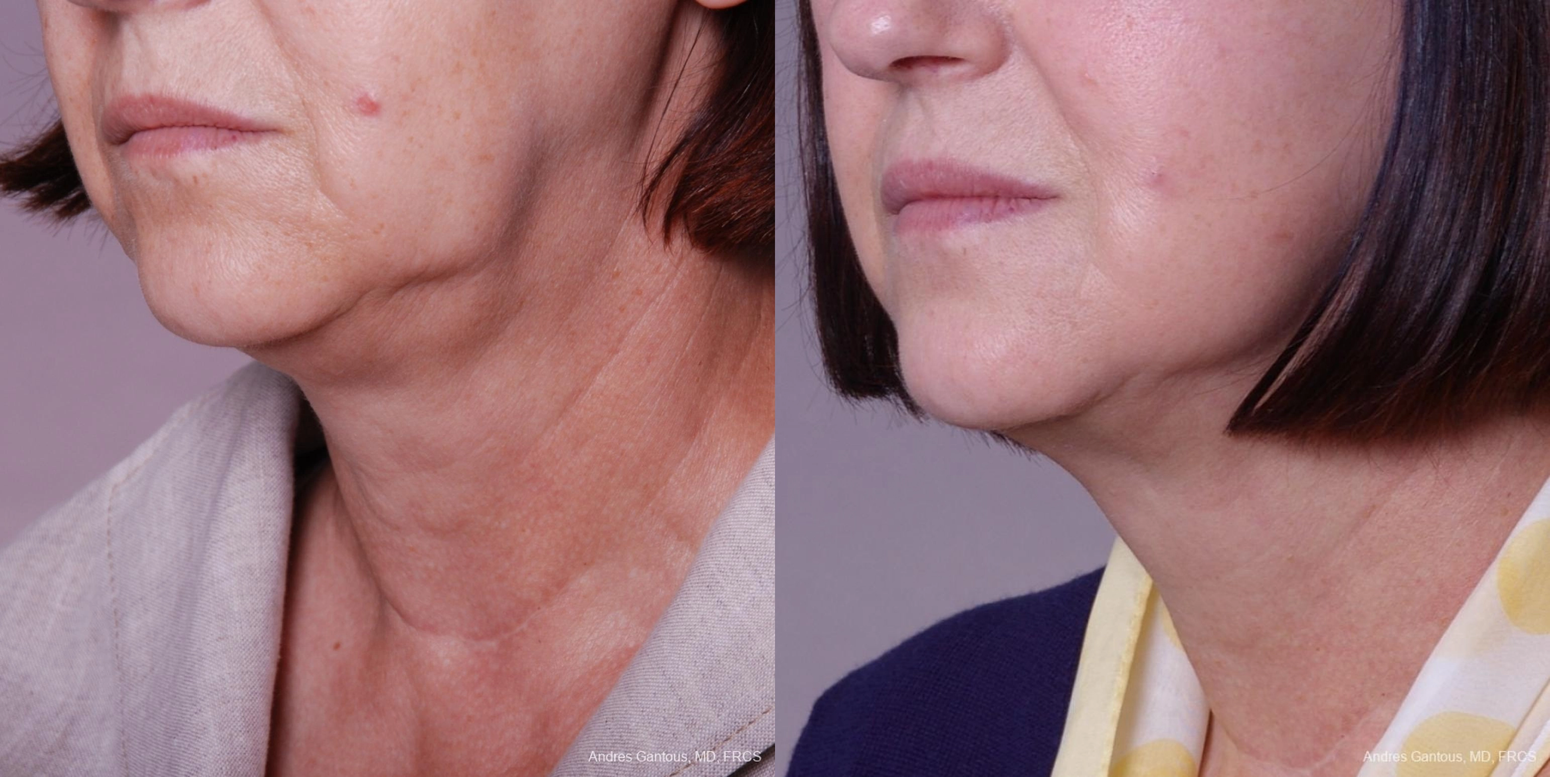 Facelift & Neck Lift - Thumbnail 2