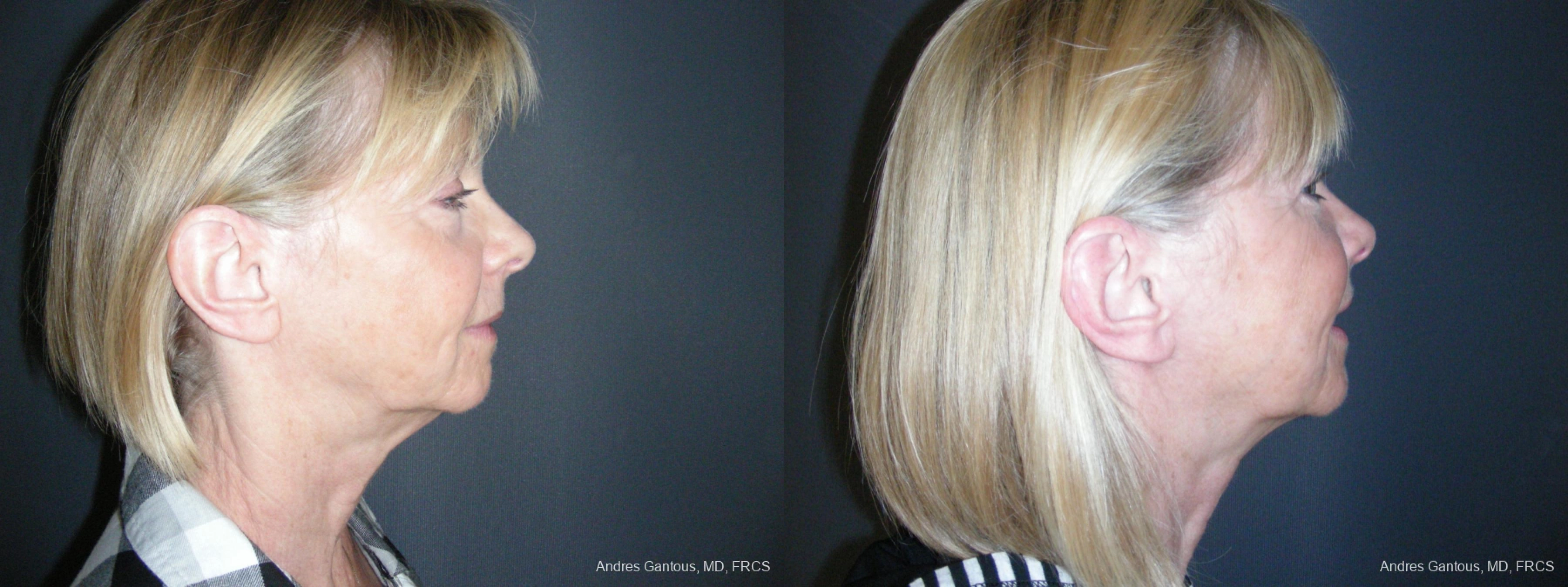 Facelift & Neck Lift - Thumbnail 3
