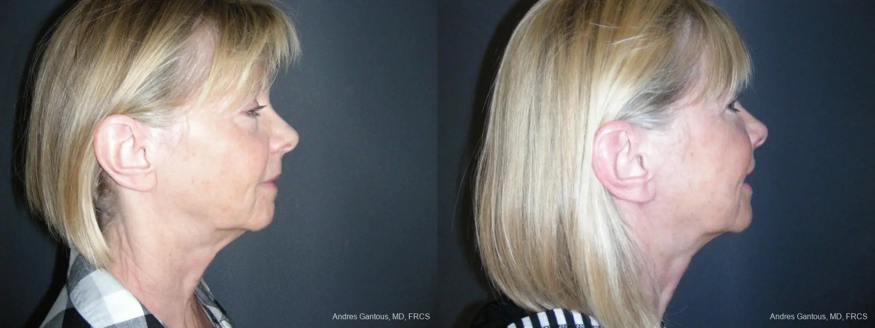 Facelift & Neck Lift: Patient 10 - Before and After 3