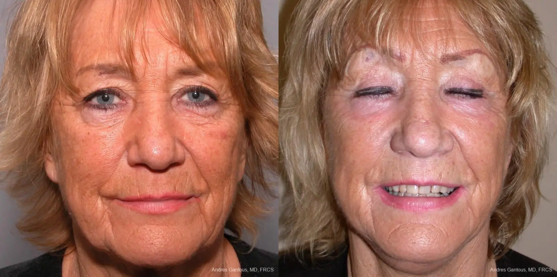 Facelift & Neck Lift: Patient 4 - Before and After  