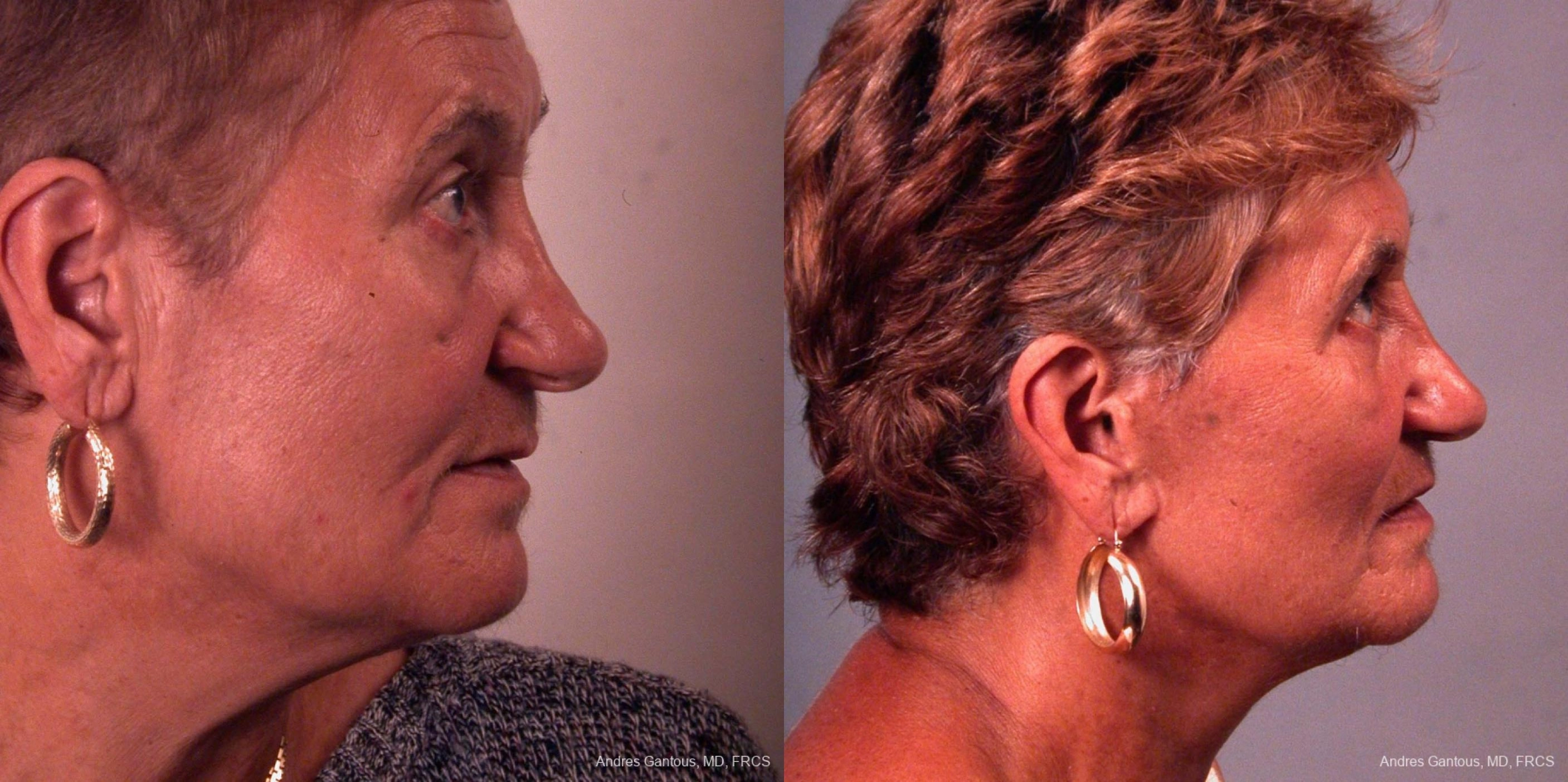 Facelift & Neck Lift - Thumbnail 2