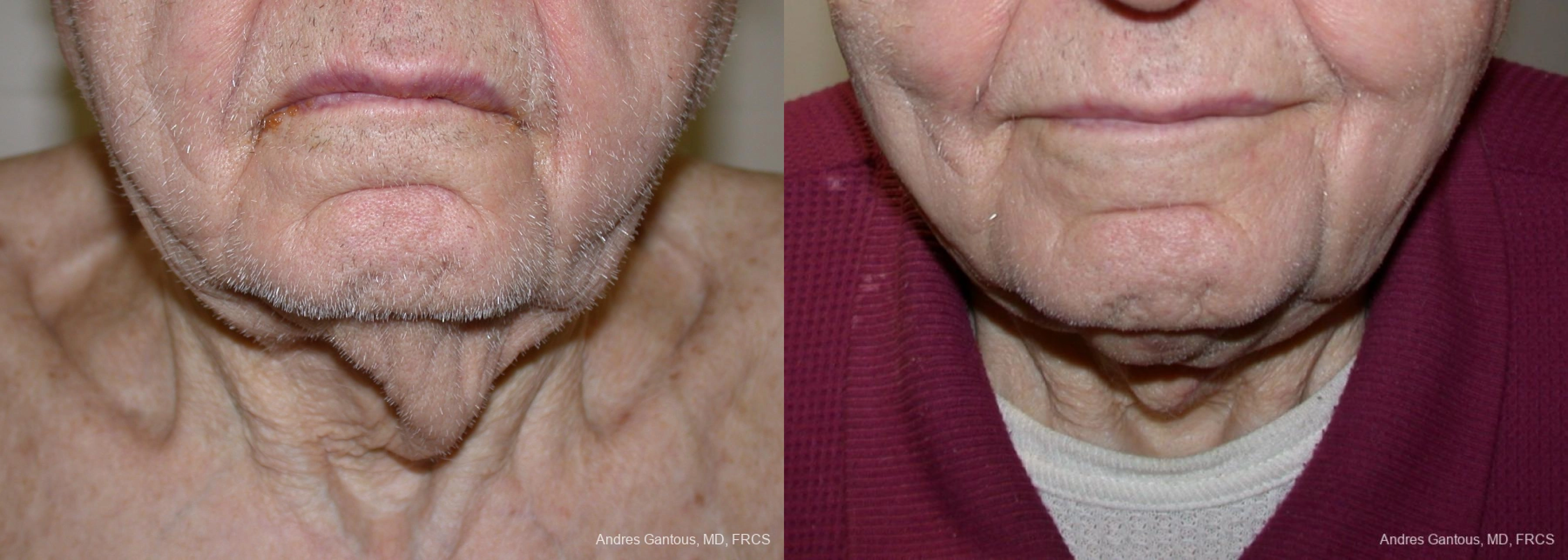 Before and after procedure result