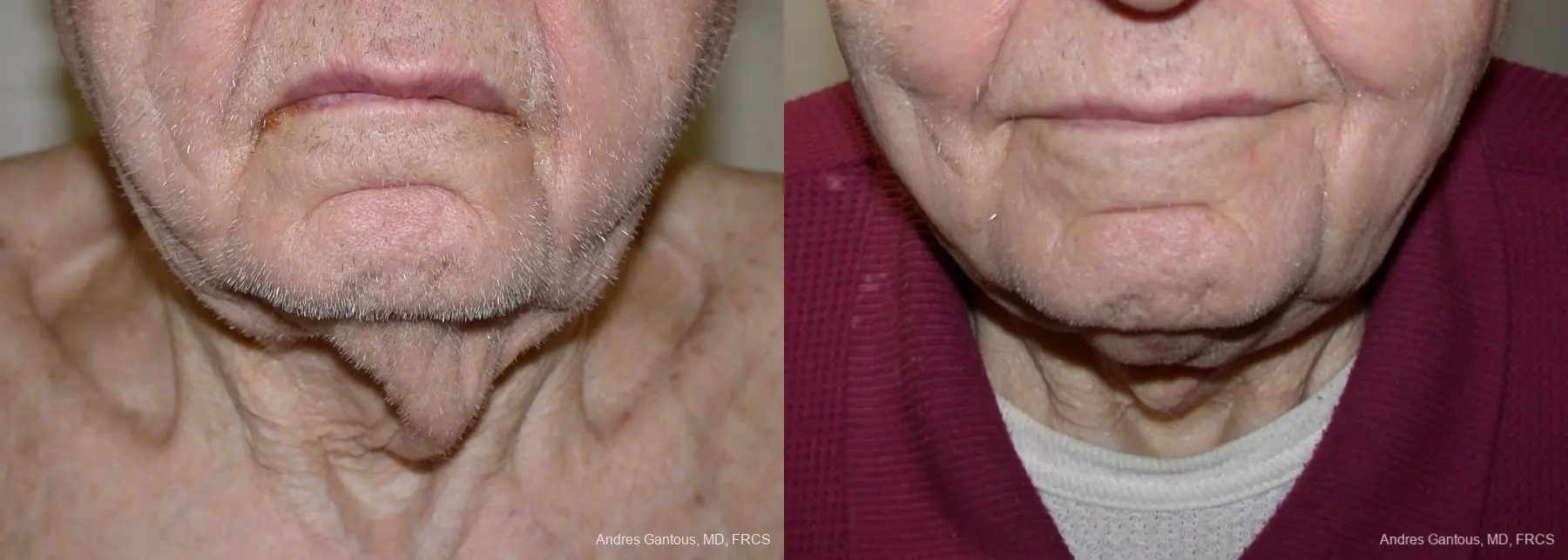 Facelift & Neck Lift: Patient 5 - Before and After  