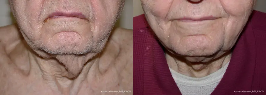 Facelift & Neck Lift: Patient 5 - Before and After 1