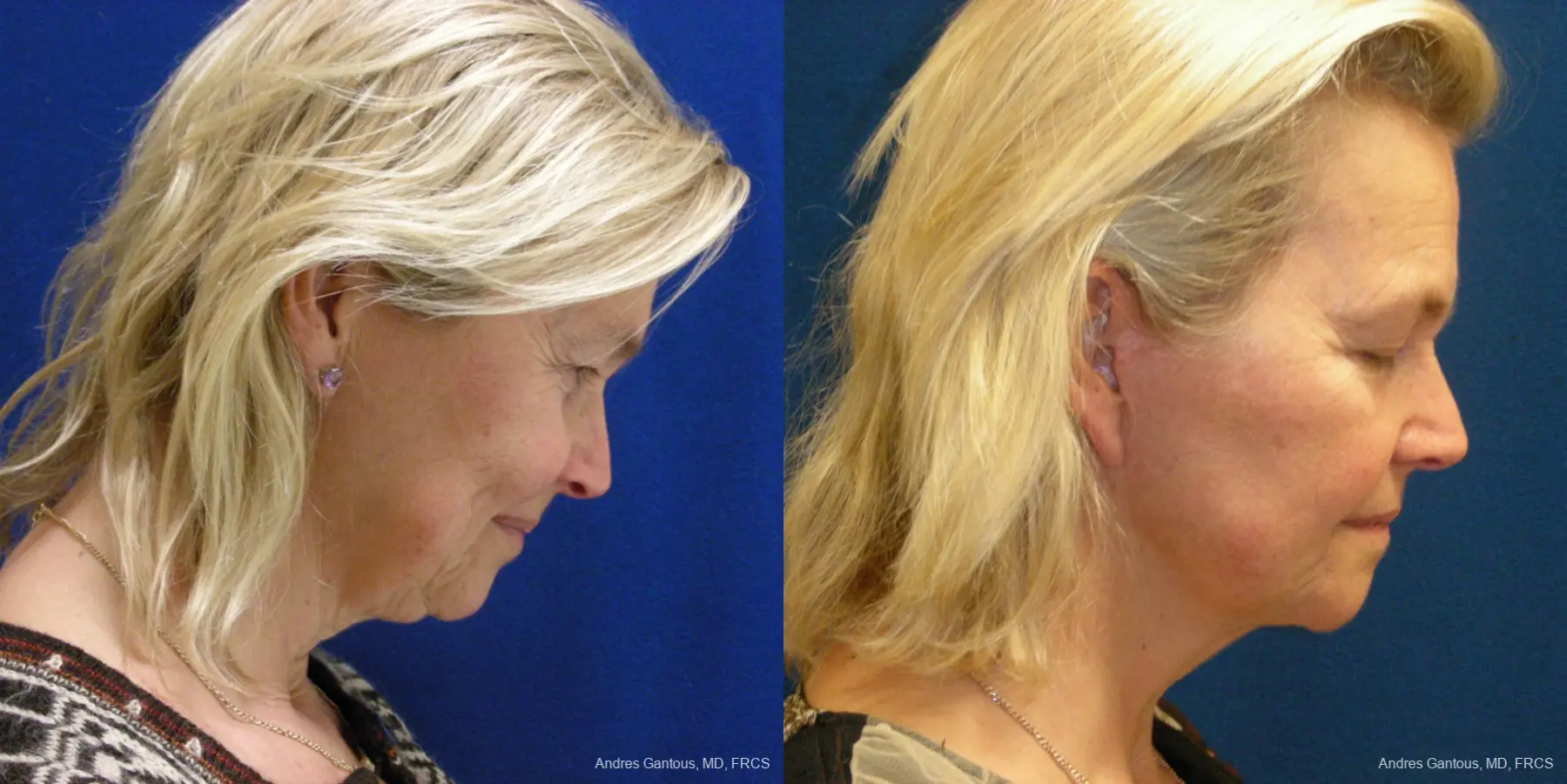 Facelift & Neck Lift: Patient 3 - Before and After 2