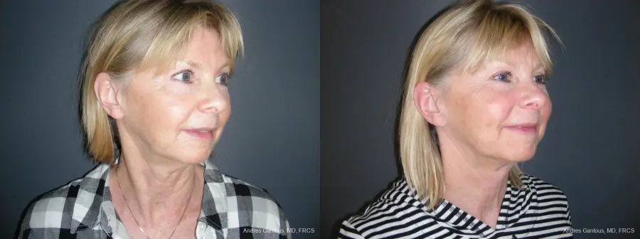 Facelift & Neck Lift: Patient 10 - Before and After 2