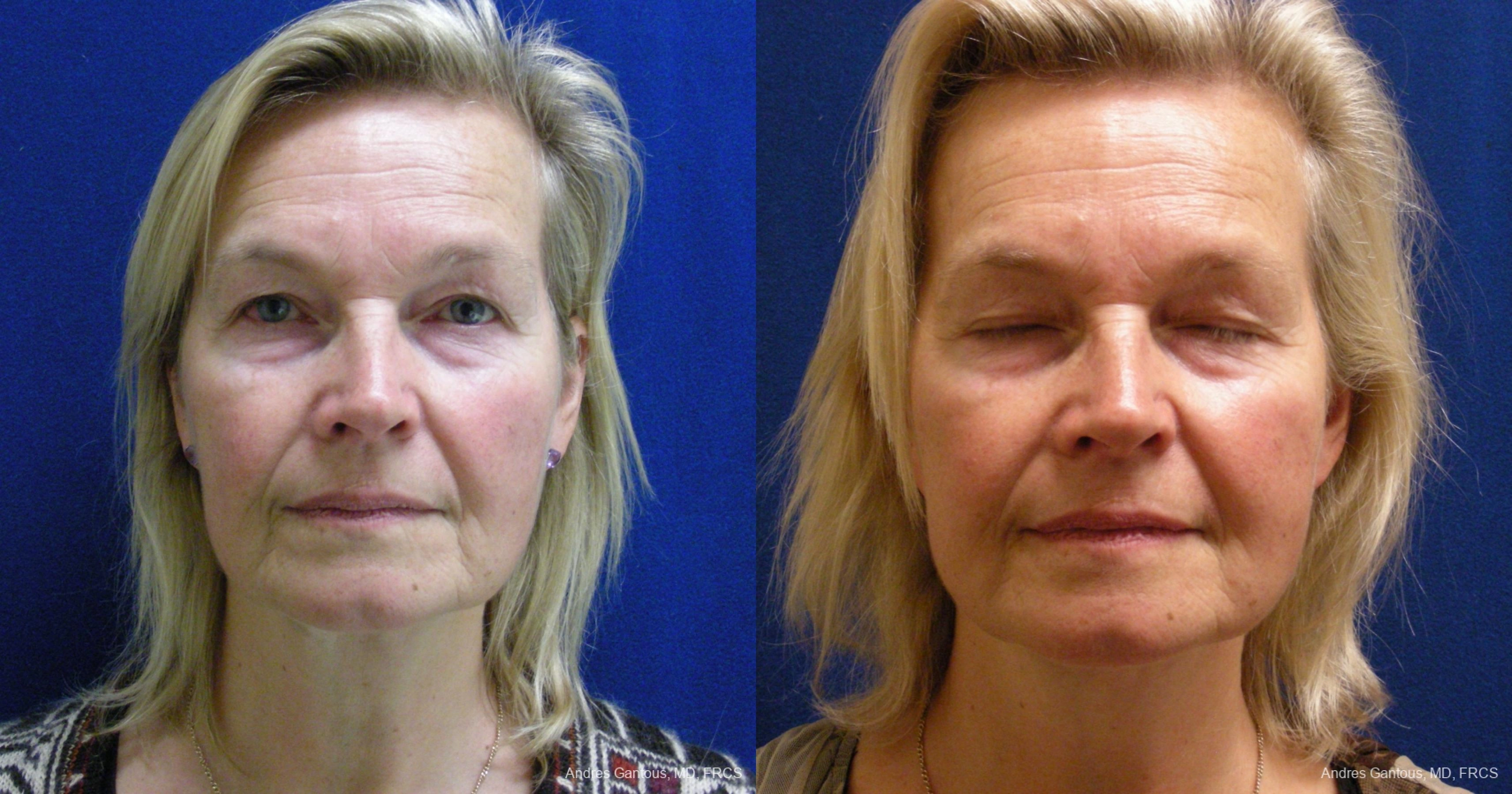 Before and after procedure result
