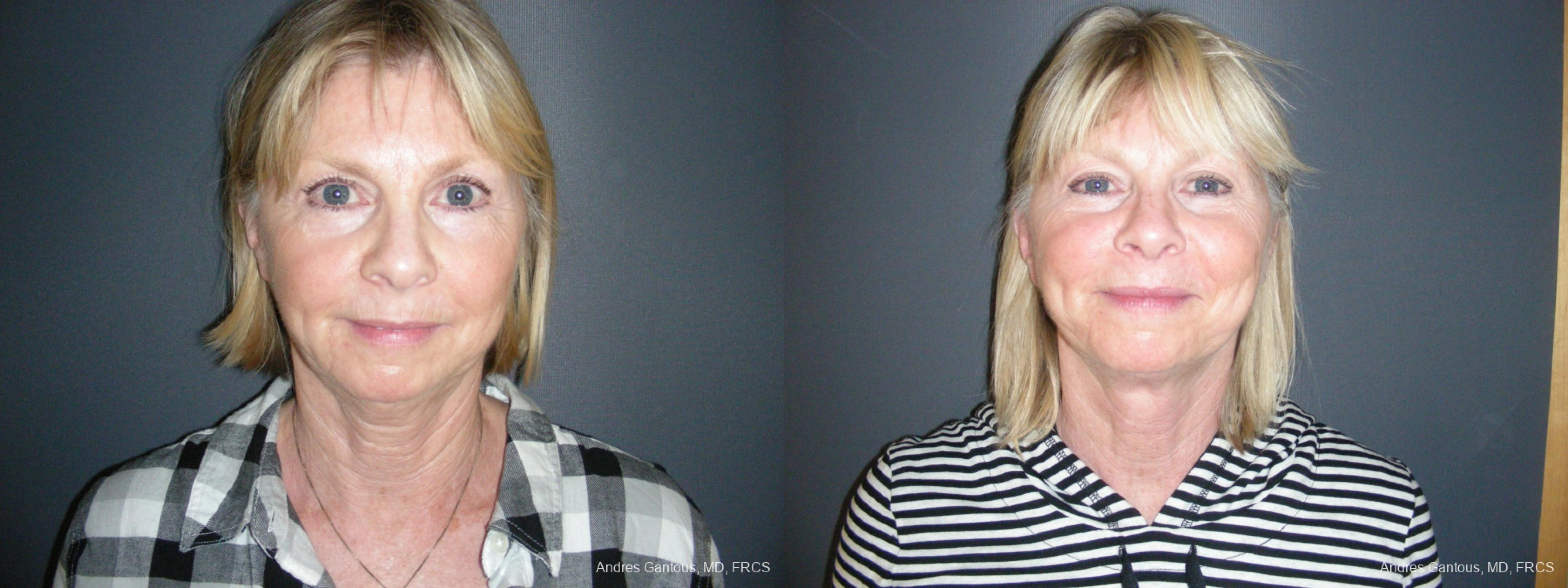 Before and after procedure result