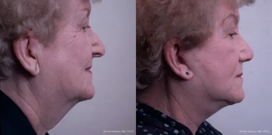 Facelift & Neck Lift: Patient 7 - Before and After 3