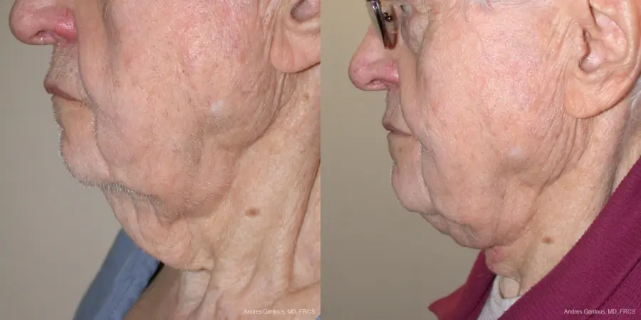 Facelift & Neck Lift: Patient 5 - Before and After 2