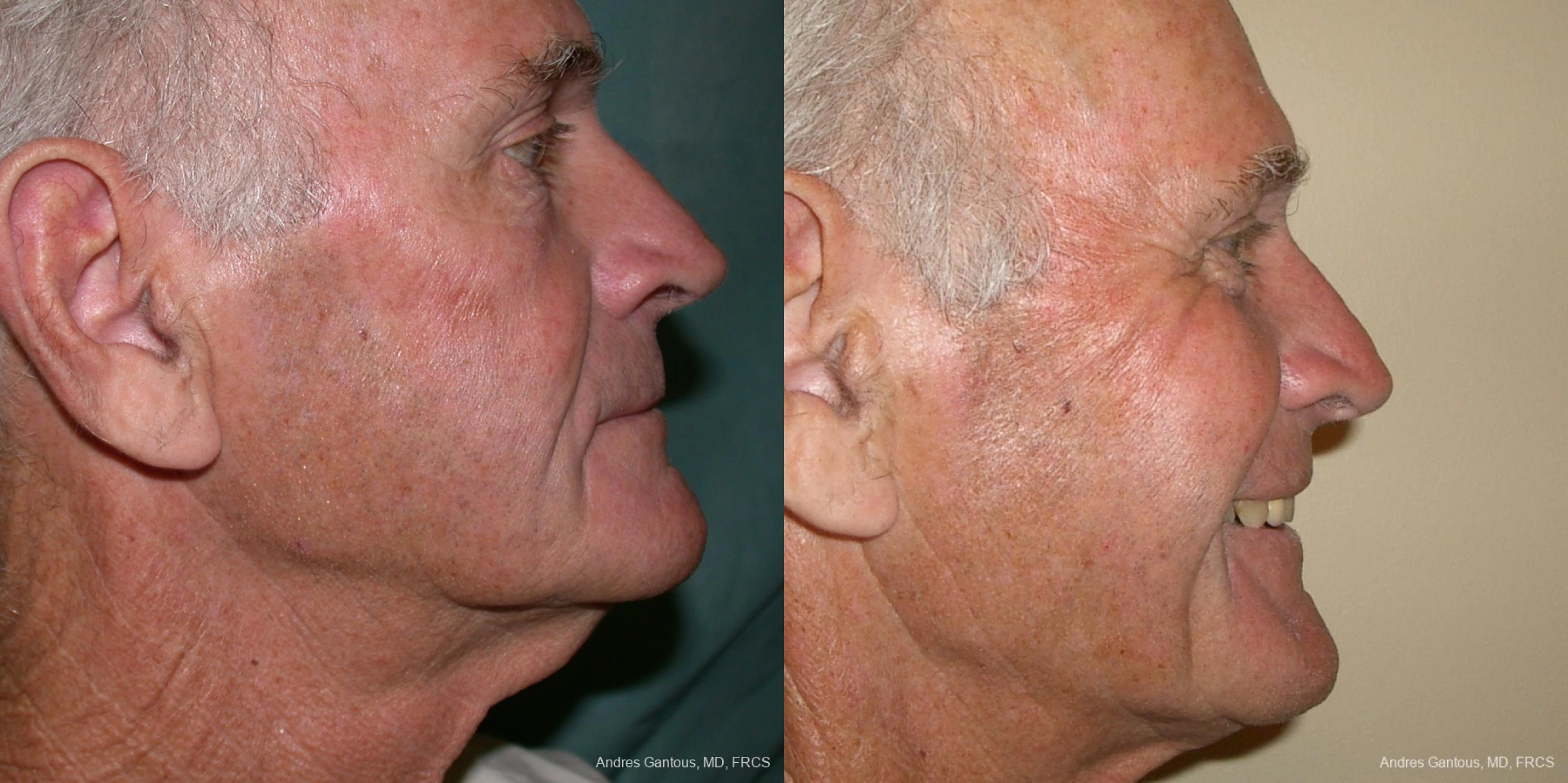 Facelift & Neck Lift - Thumbnail 2