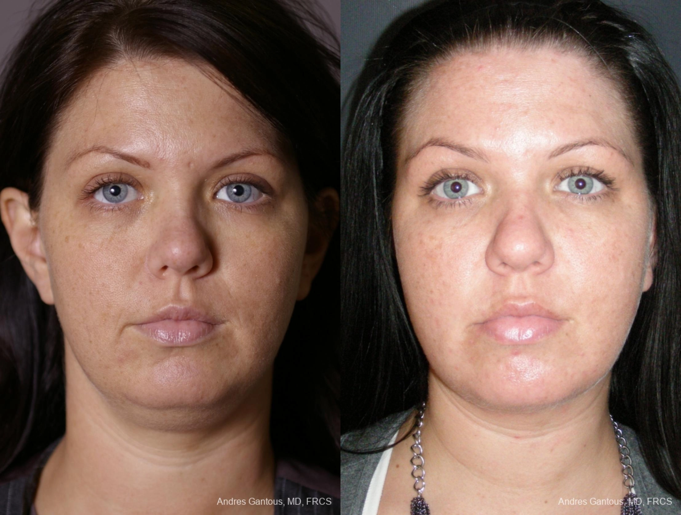 Before and after procedure result