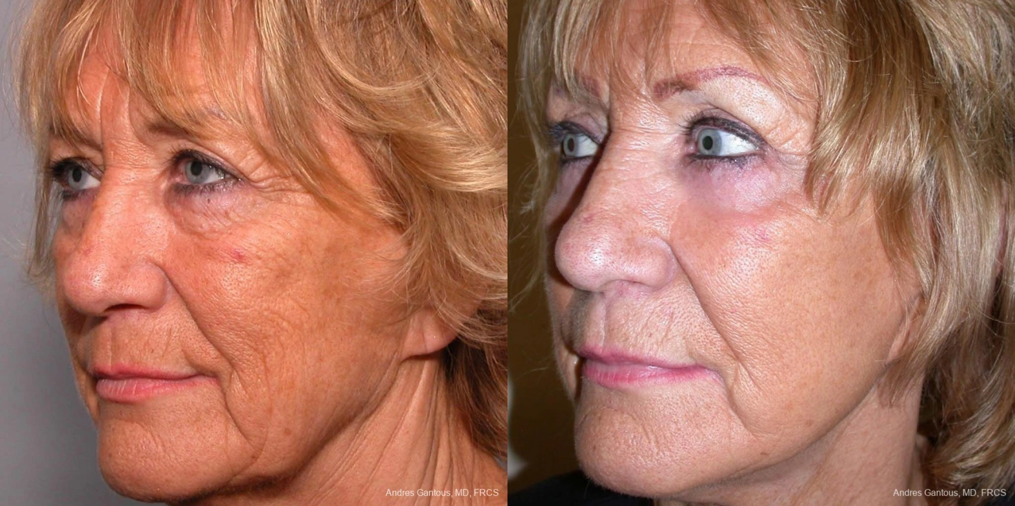 Facelift & Neck Lift - Thumbnail 2