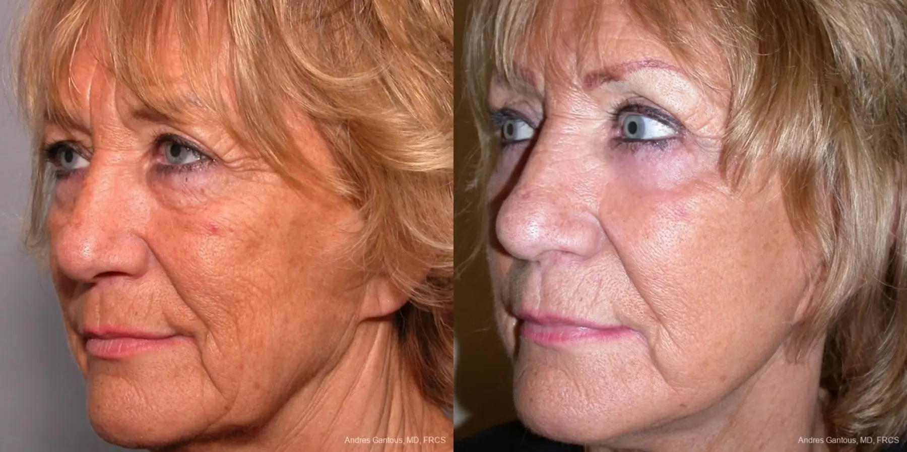 Facelift & Neck Lift: Patient 4 - Before and After 2