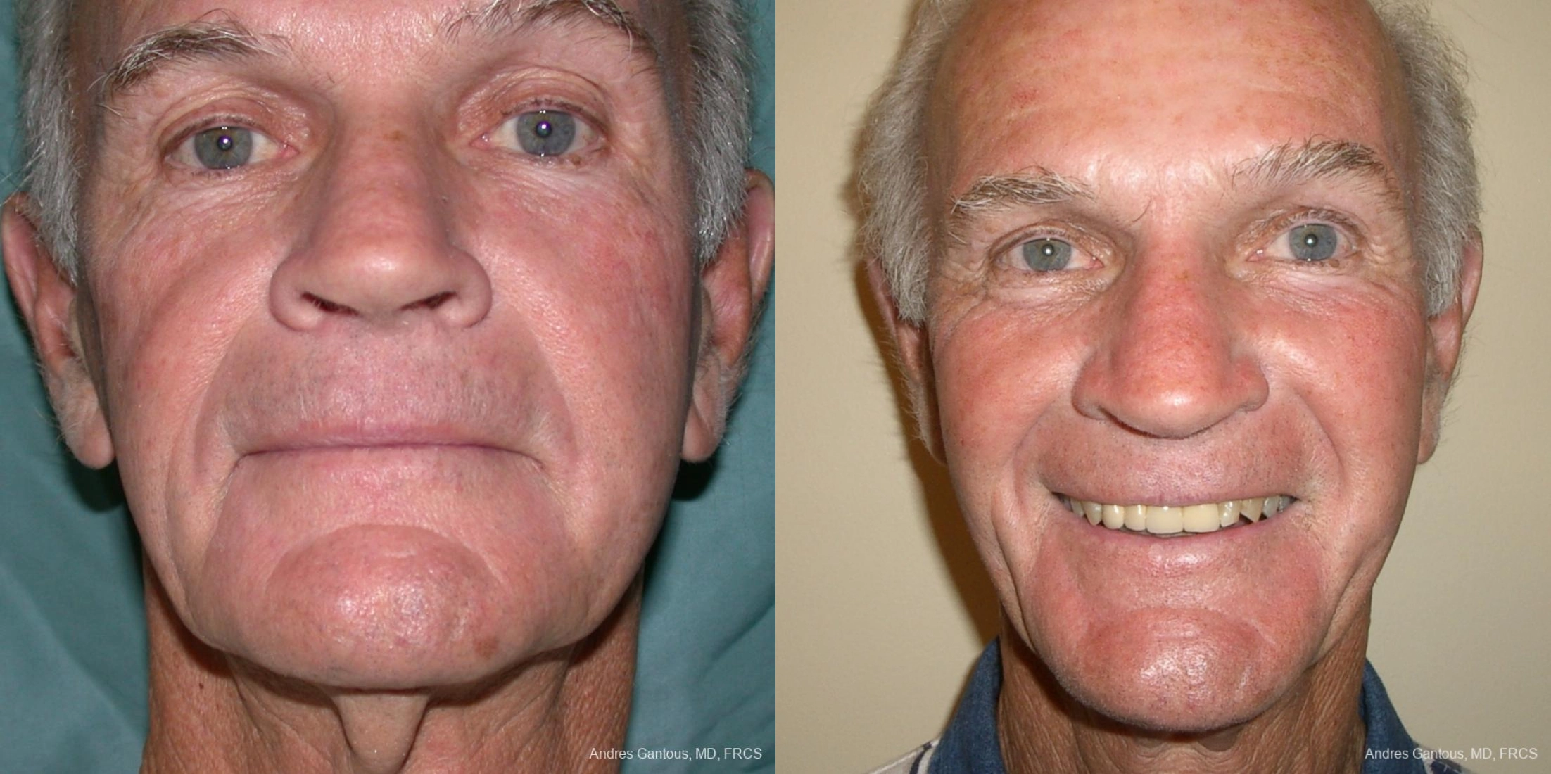 Before and after procedure result