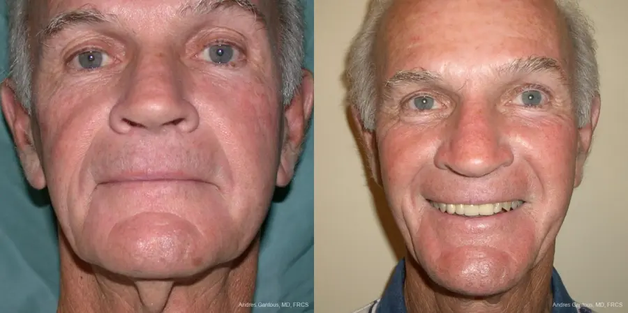 Facelift & Neck Lift: Patient 1 - Before and After 1
