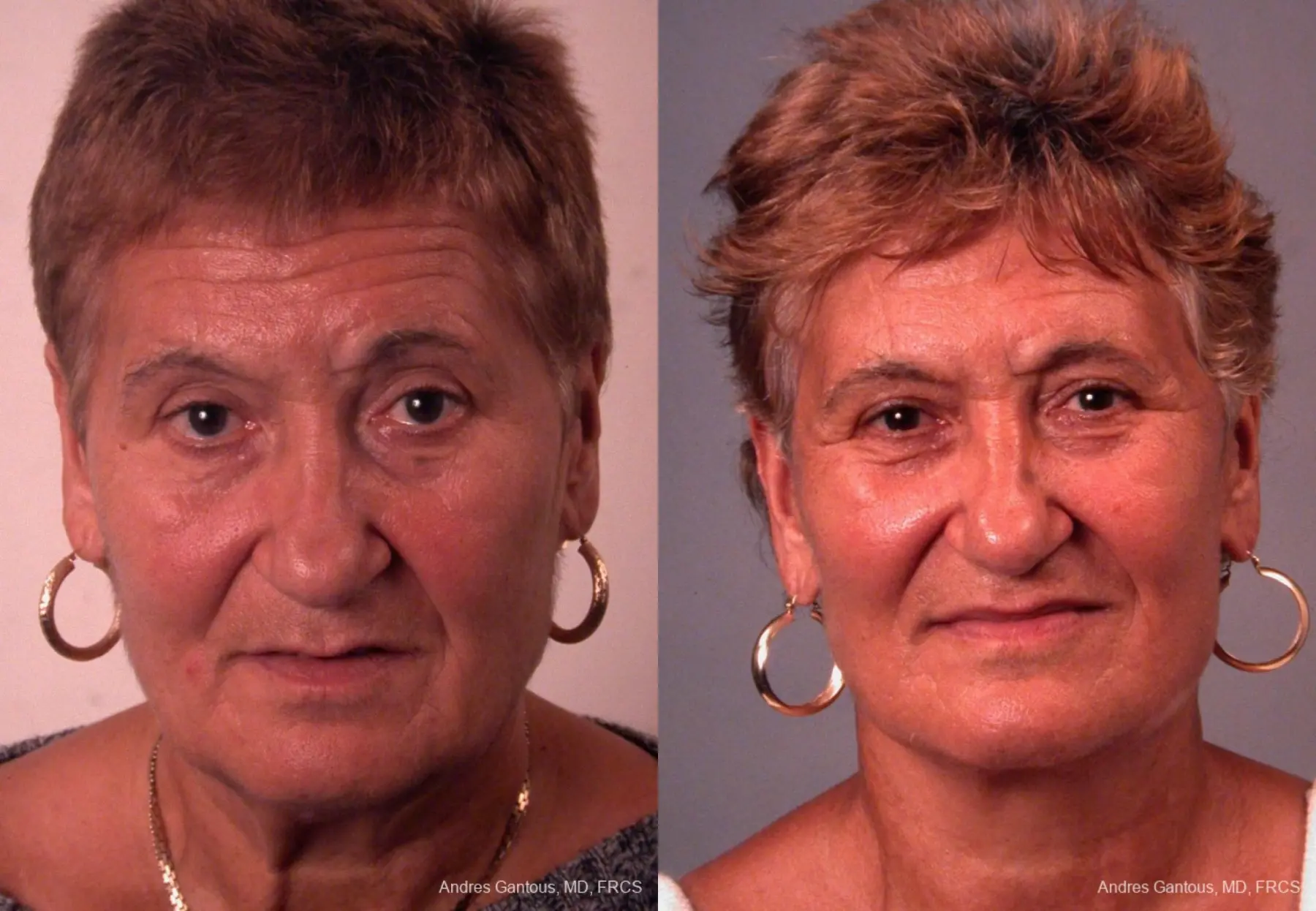 Facelift & Neck Lift: Patient 8 - Before and After 1