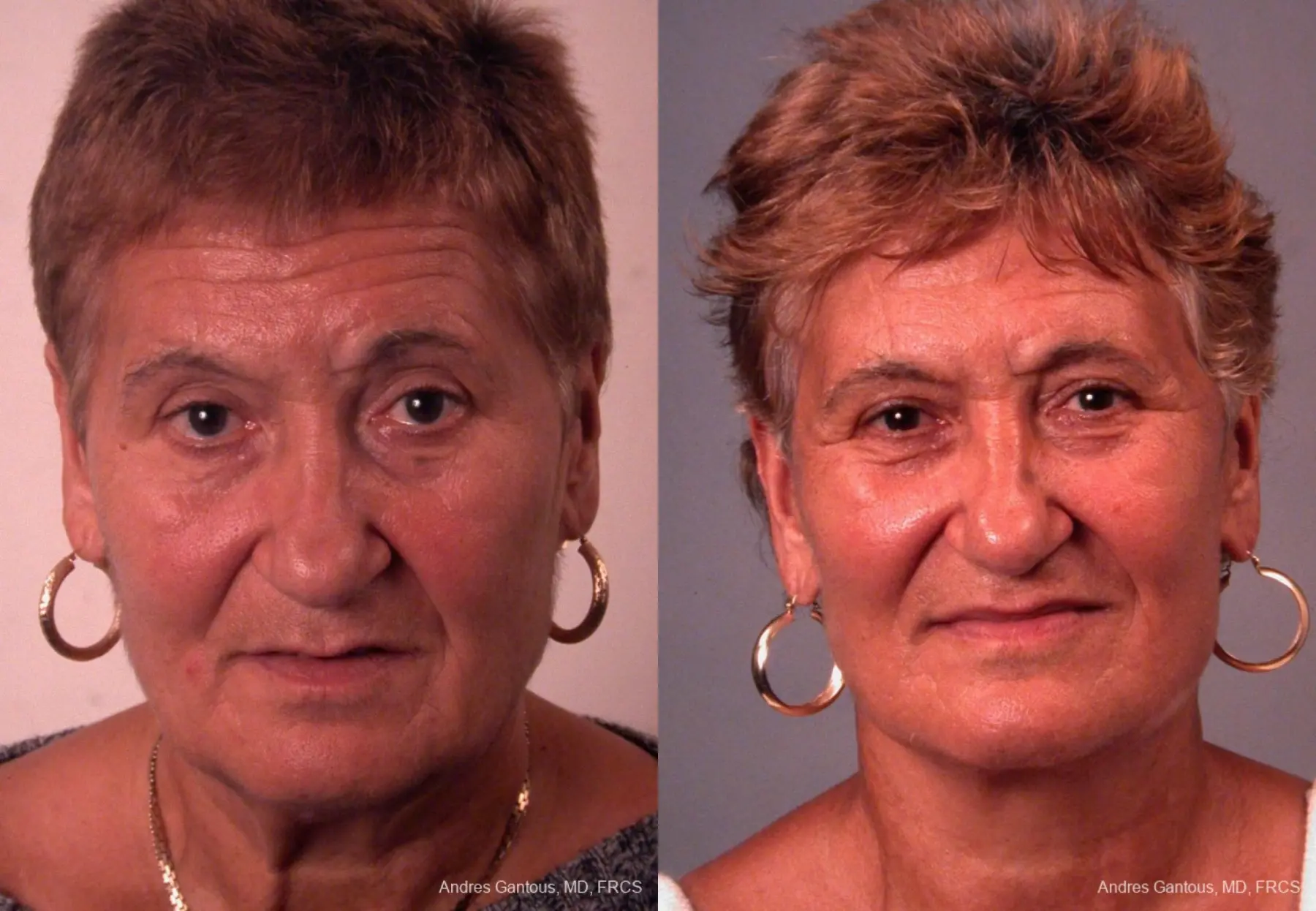 Facelift & Neck Lift: Patient 8 - Before and After  