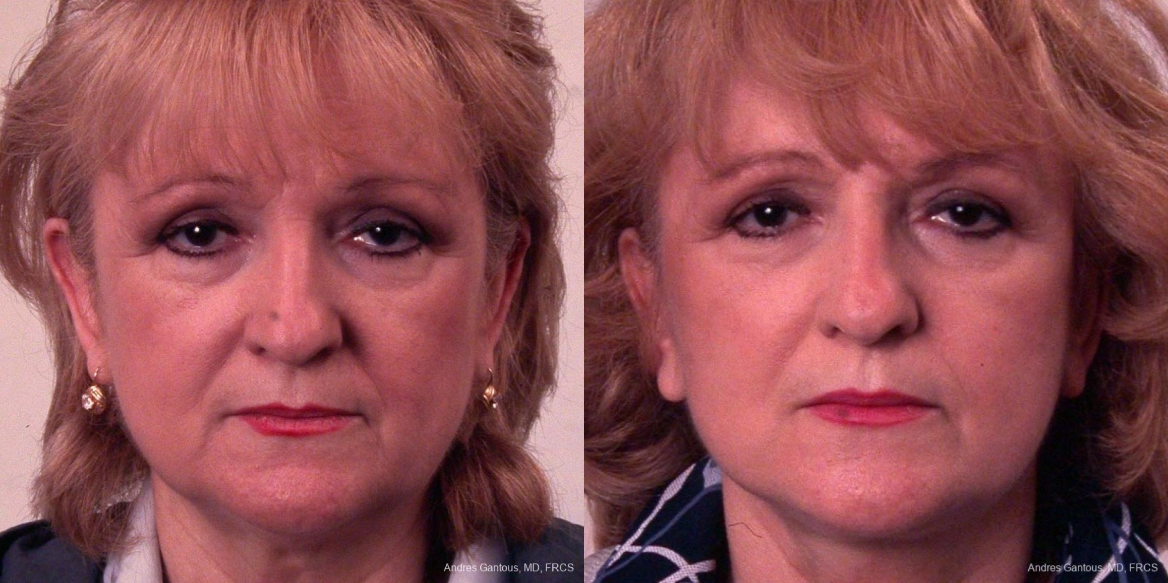 Before and after procedure result
