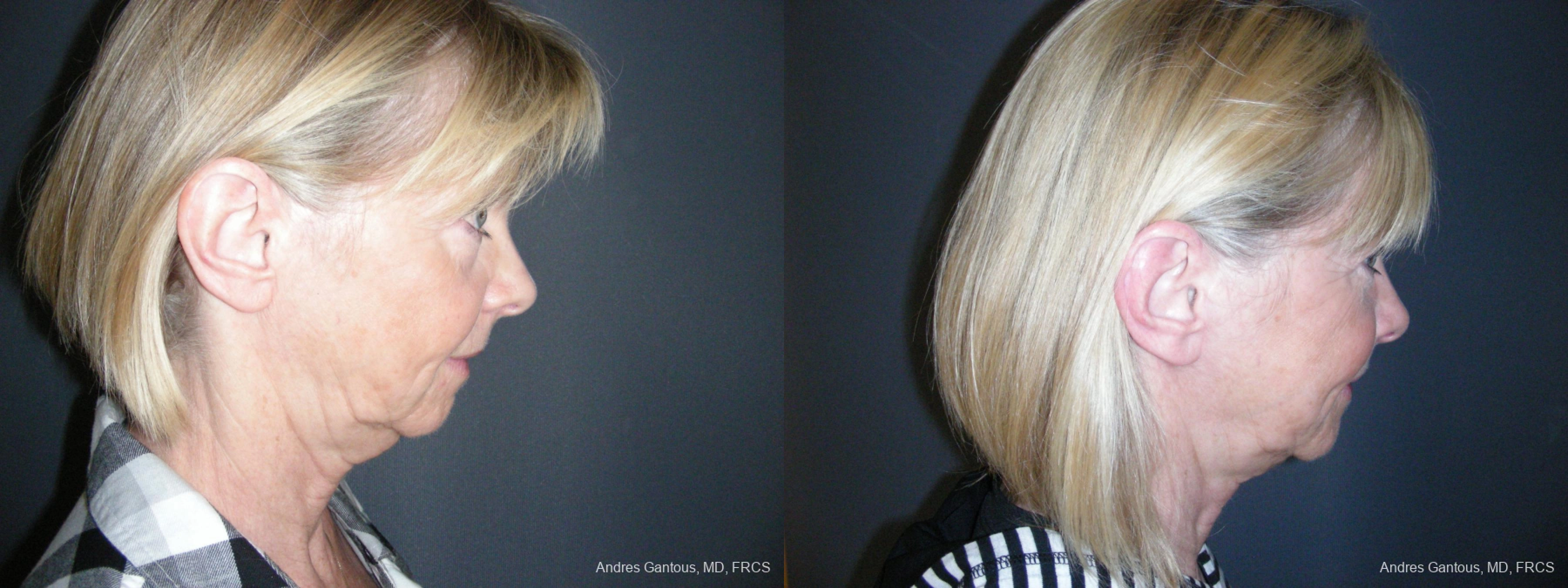 Facelift & Neck Lift - Thumbnail 6