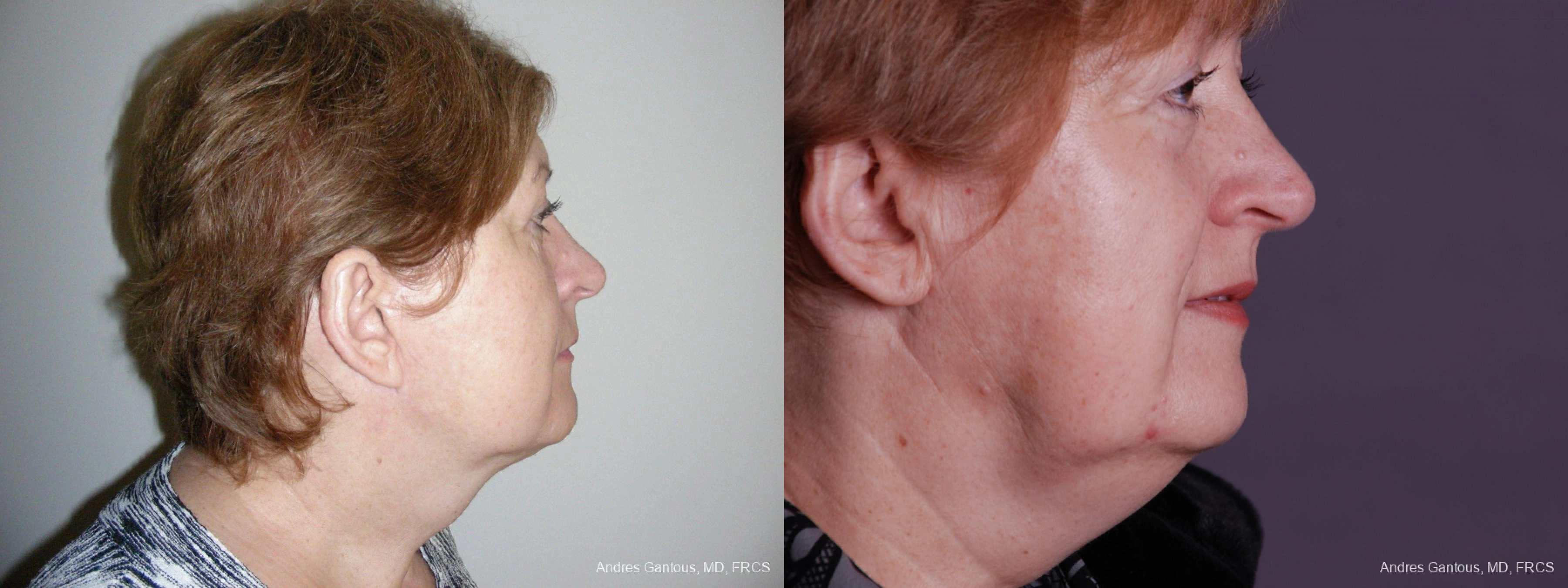 Facelift & Neck Lift - Thumbnail 3