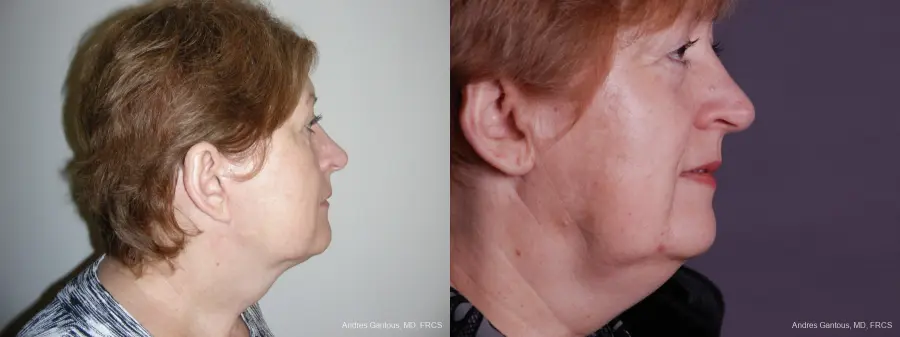 Facelift & Neck Lift: Patient 9 - Before and After 3