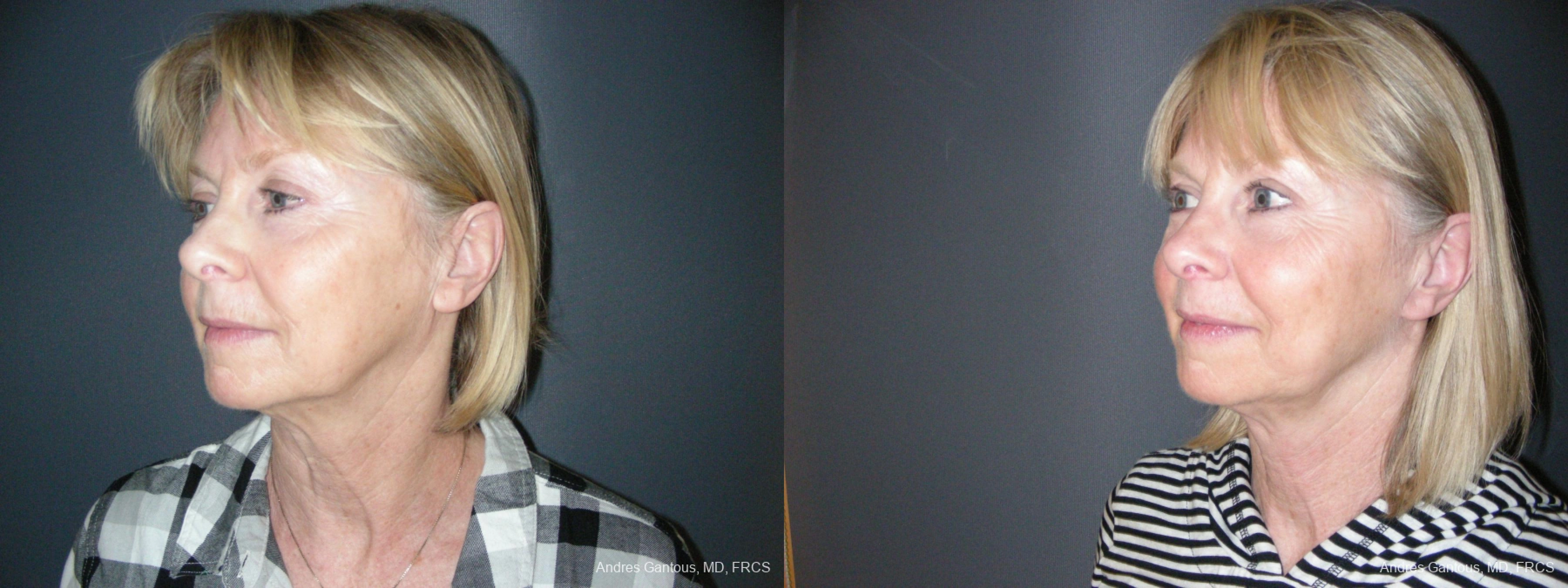 Facelift & Neck Lift - Thumbnail 4