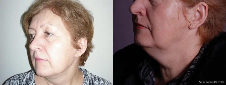 Facelift & Neck Lift: Patient 9 - Before and After 4
