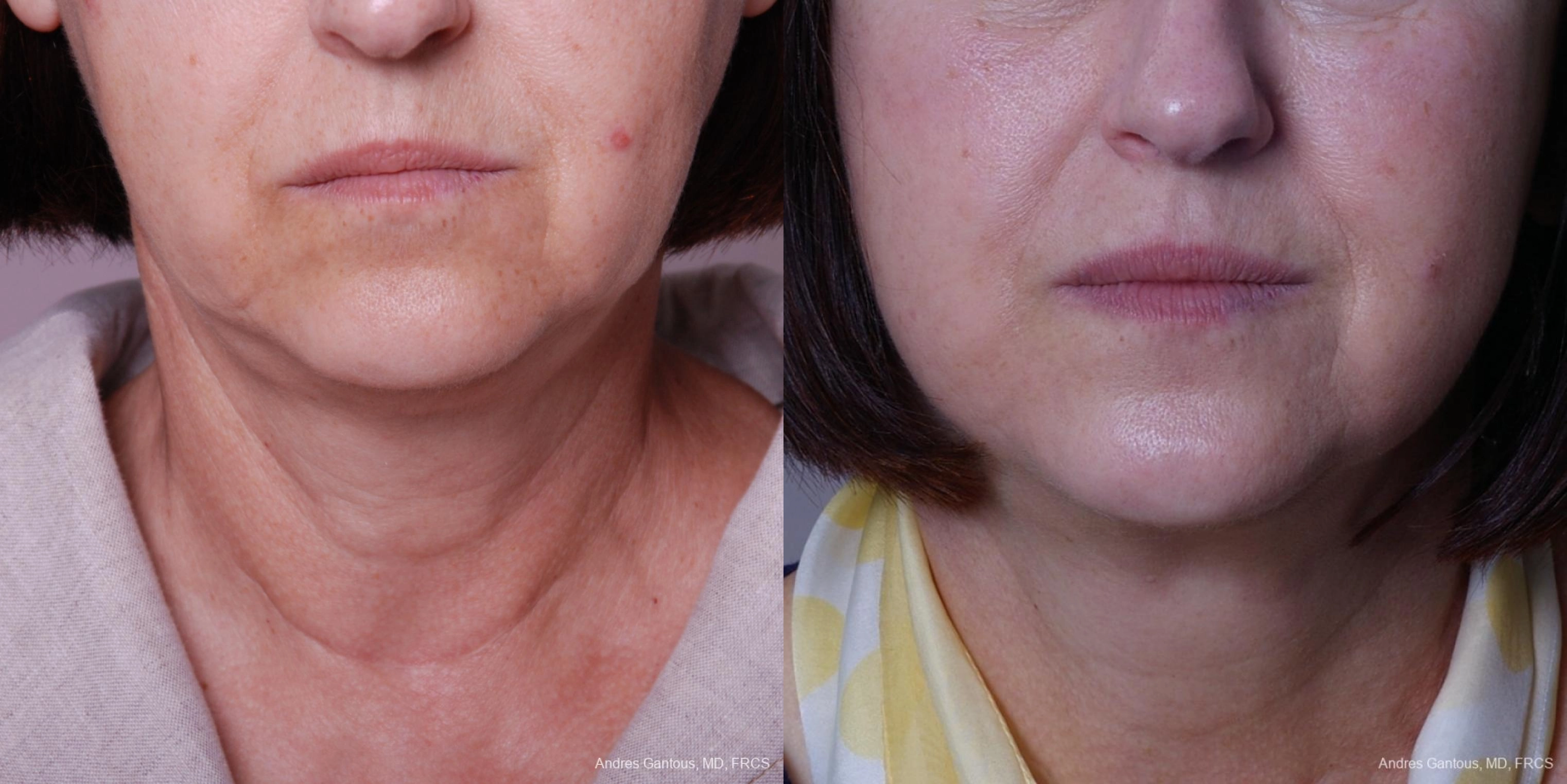 Before and after procedure result