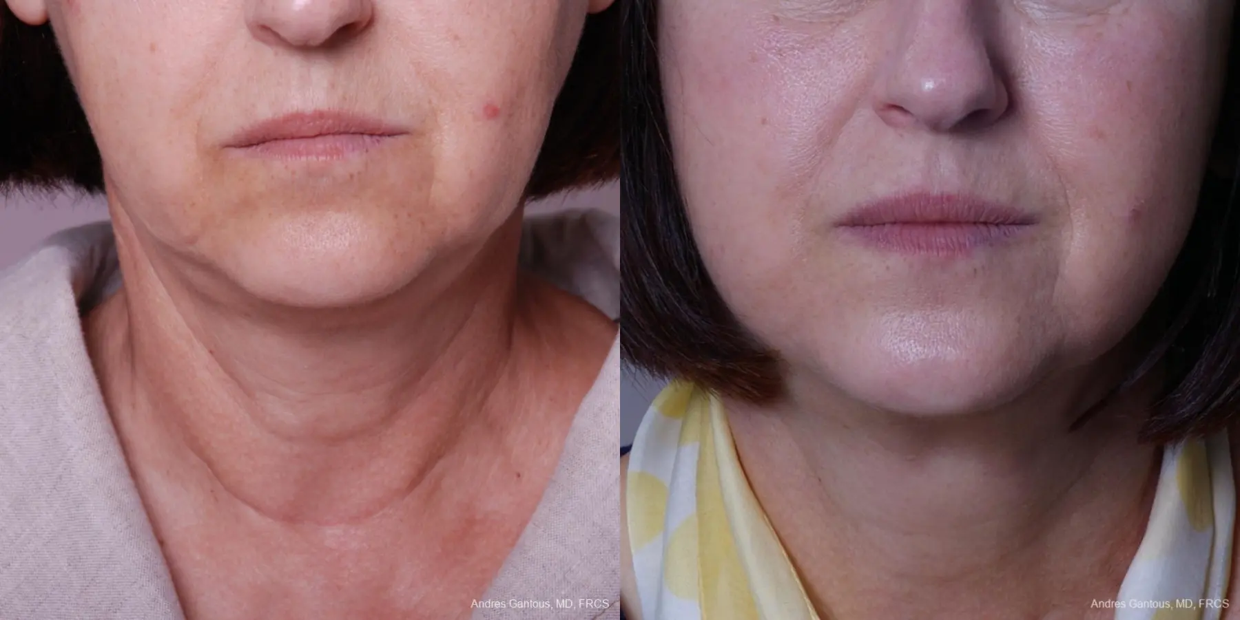 Facelift & Neck Lift: Patient 2 - Before and After 1