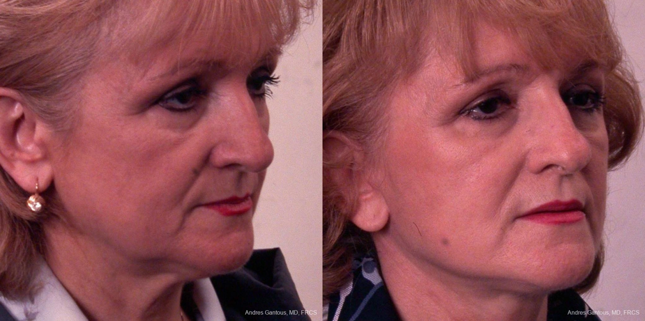 Facelift & Neck Lift - Thumbnail 2