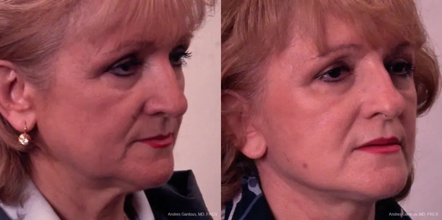 Facelift & Neck Lift: Patient 6 - Before and After 2