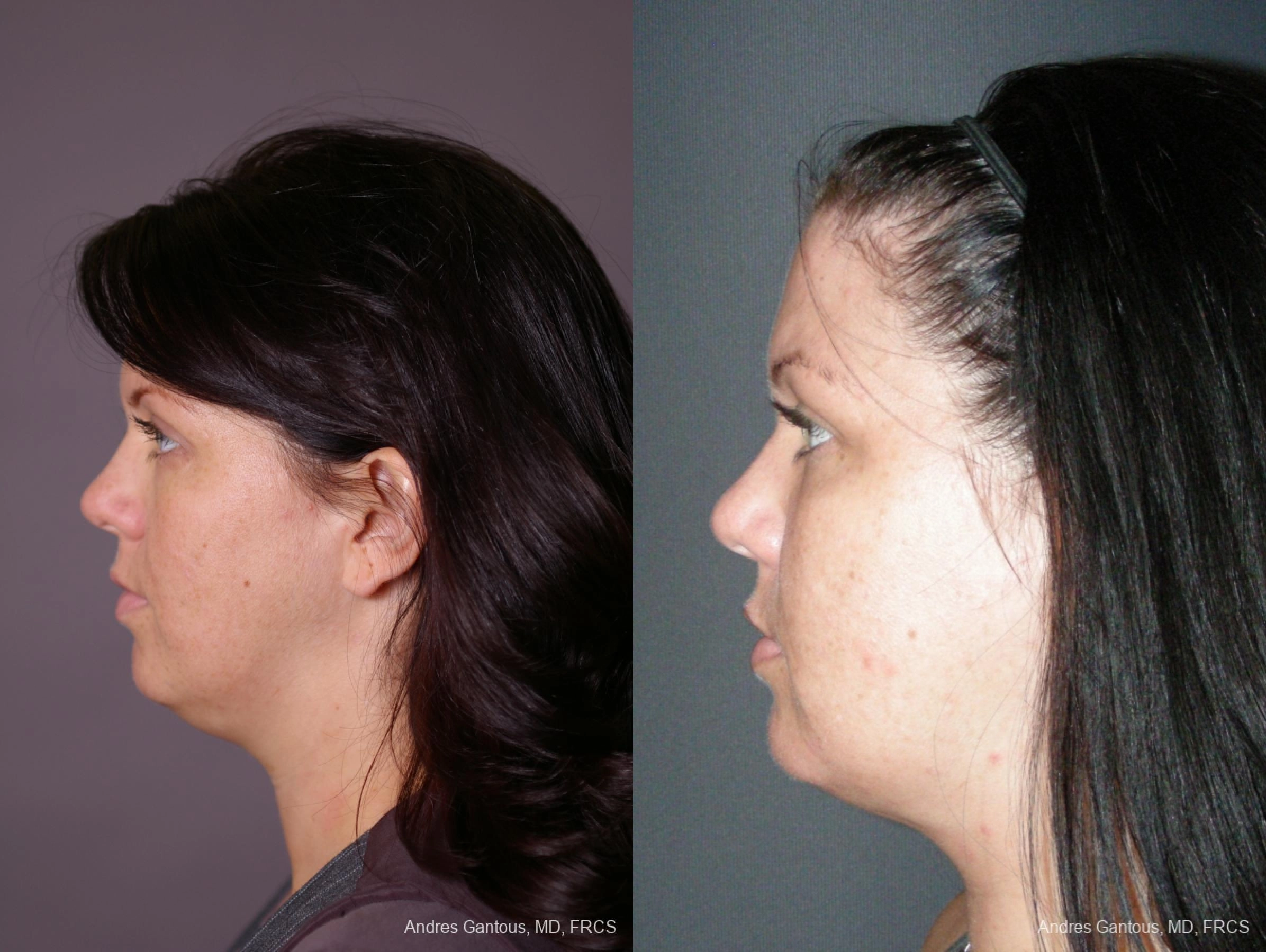 Facelift & Neck Lift - Thumbnail 5