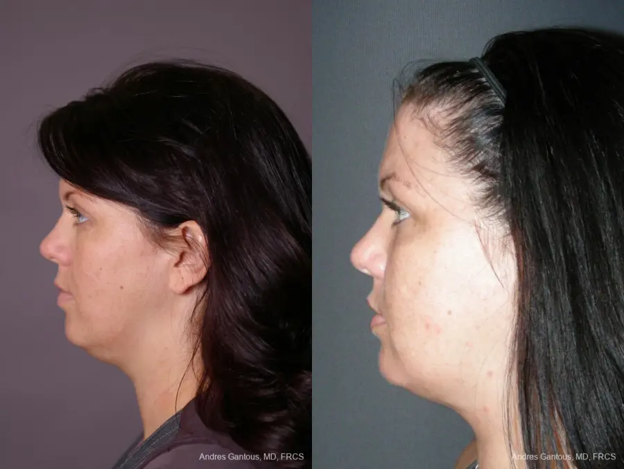 Facelift & Neck Lift: Patient 11 - Before and After 5