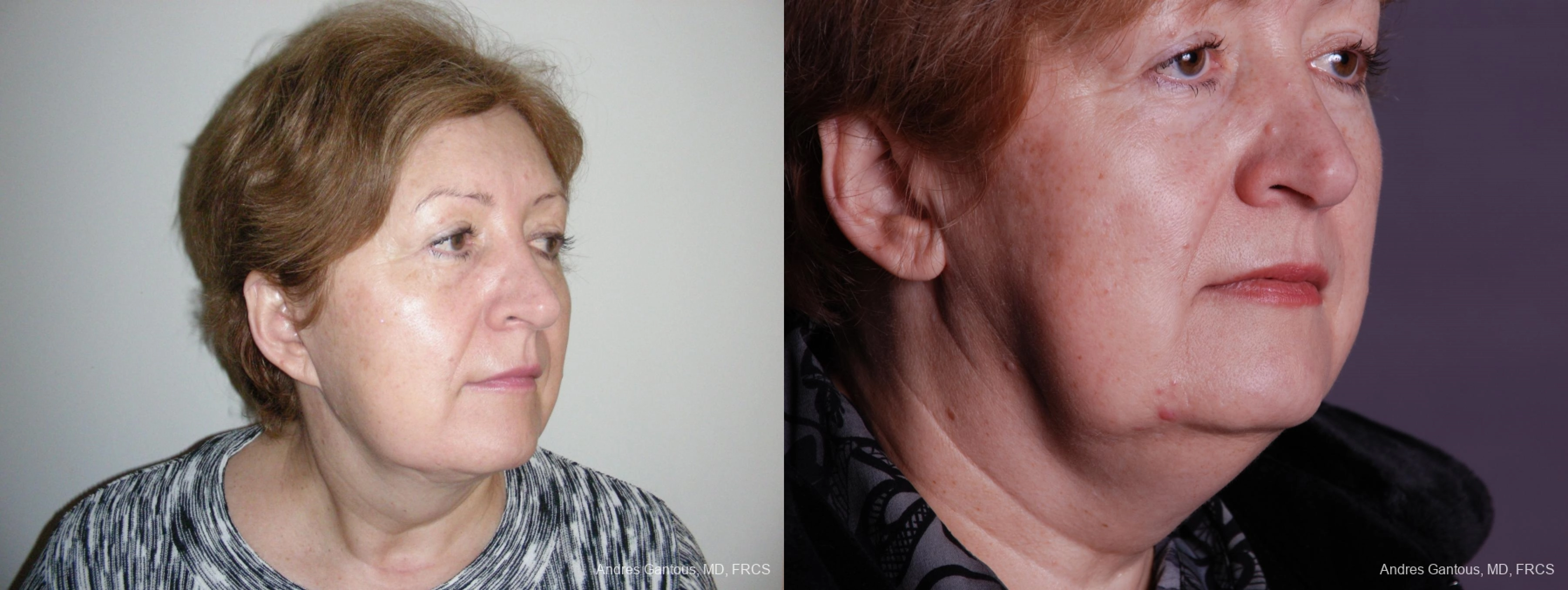 Facelift & Neck Lift - Thumbnail 2