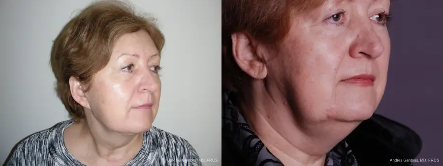 Facelift & Neck Lift: Patient 9 - Before and After 2