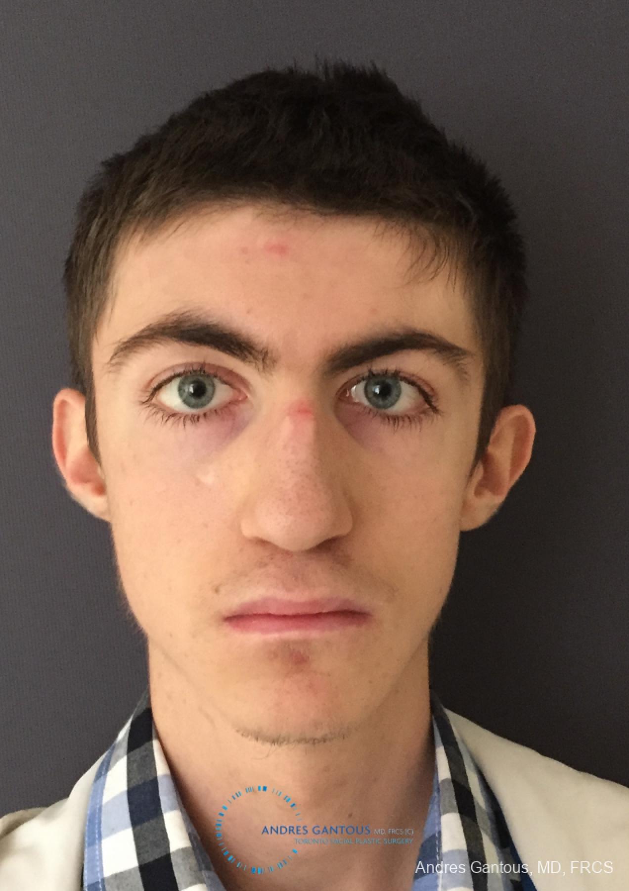 Rhinoplasty: Patient 78 - Before 
