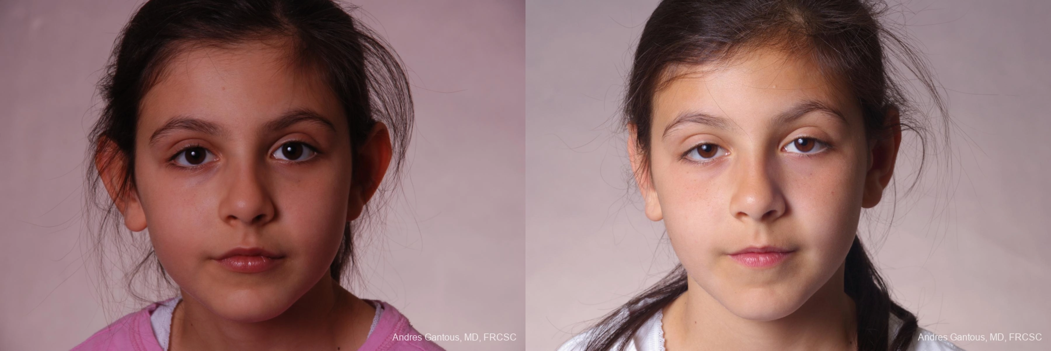 Otoplasty and Earlobe Repair - Case 11673