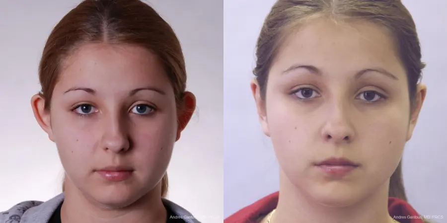 Otoplasty And Earlobe Repair: Patient 15 - Before and After