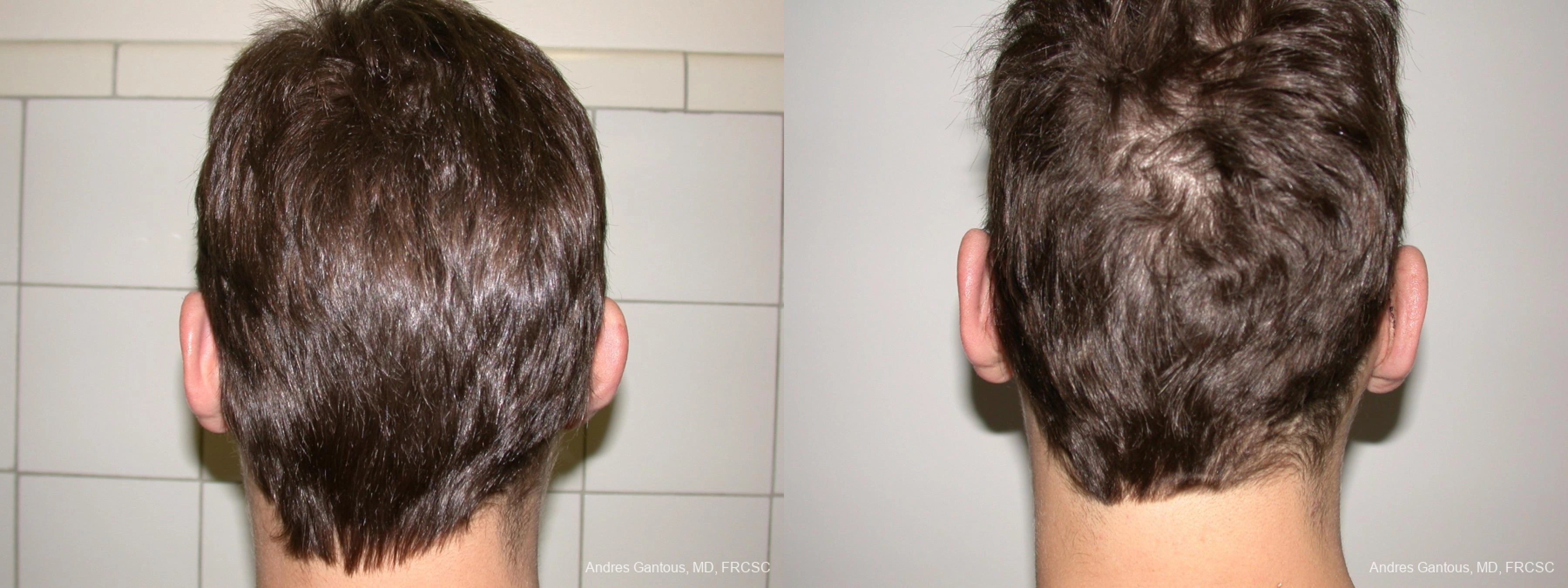 Otoplasty and Earlobe Repair - Thumbnail 4