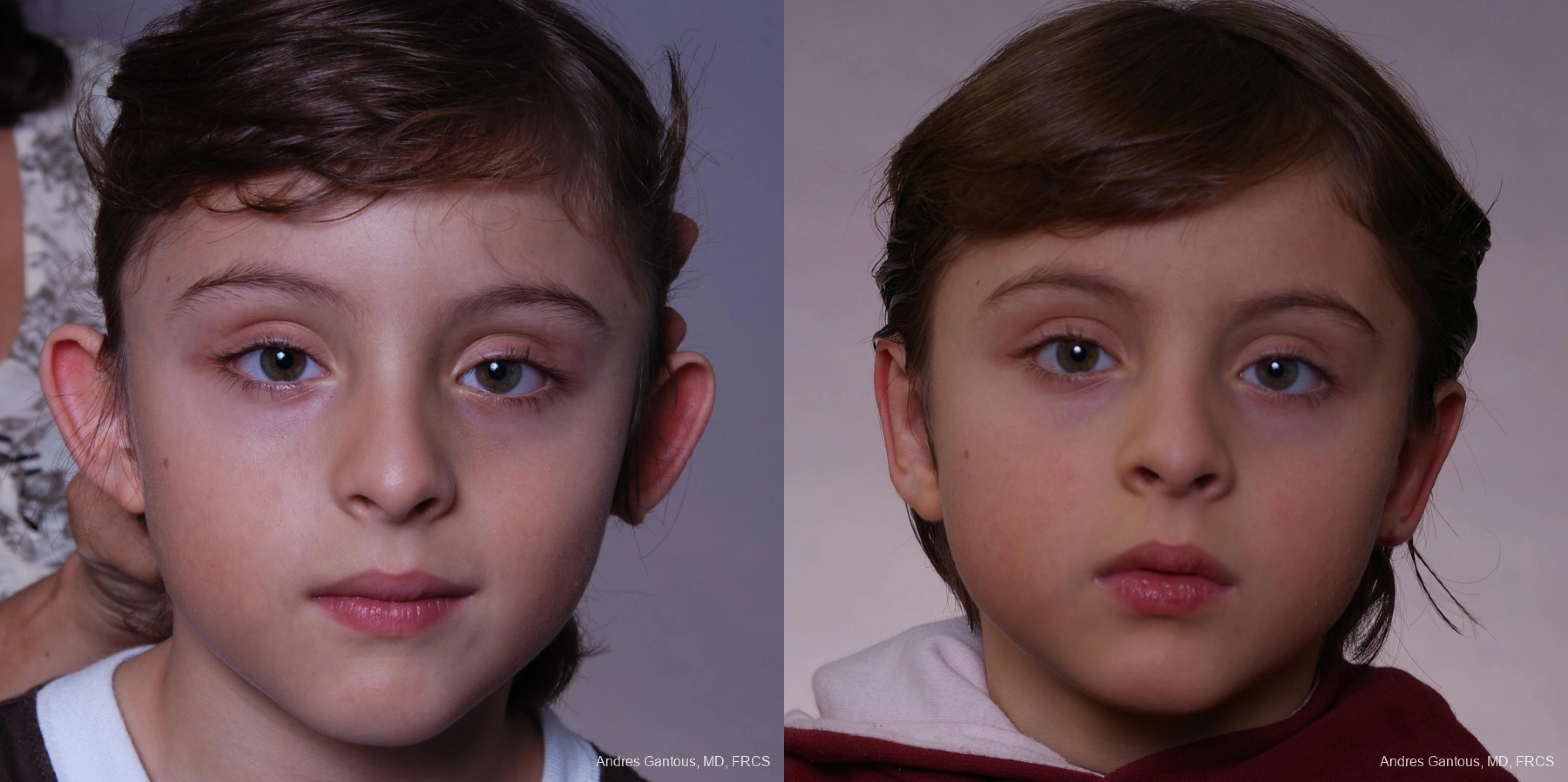 Otoplasty and Earlobe Repair - Case 11694