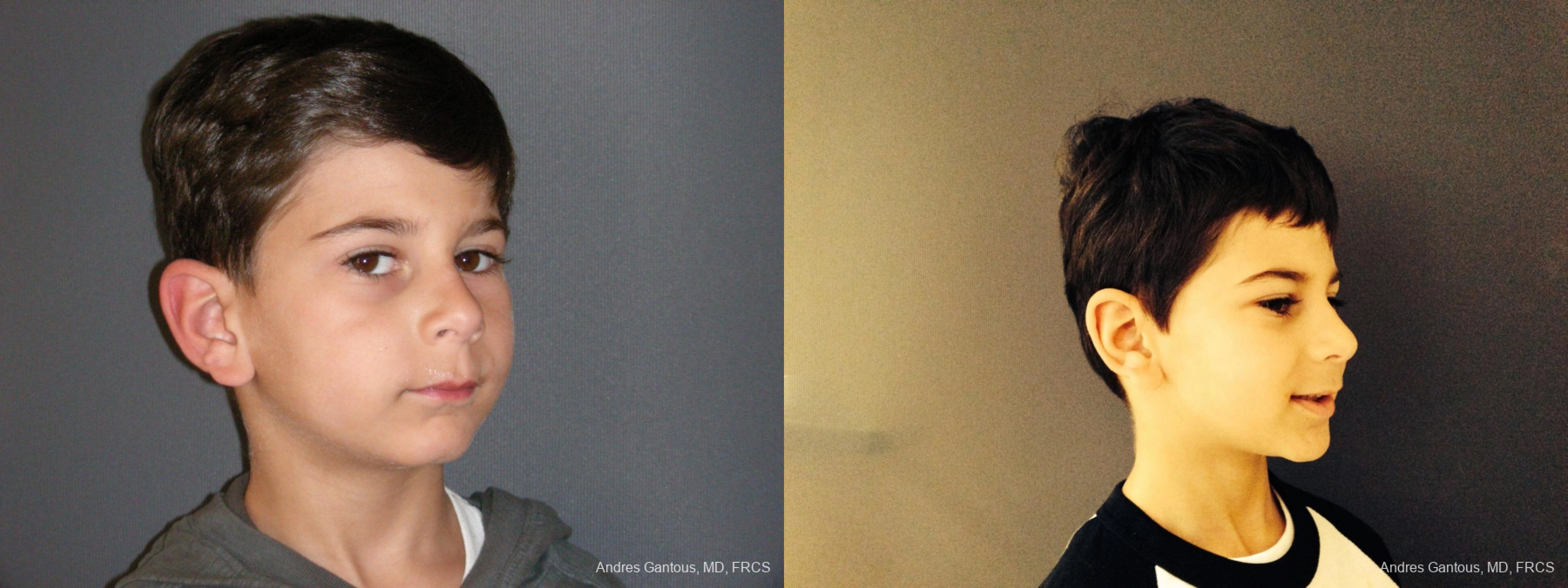 Otoplasty and Earlobe Repair - Thumbnail 2