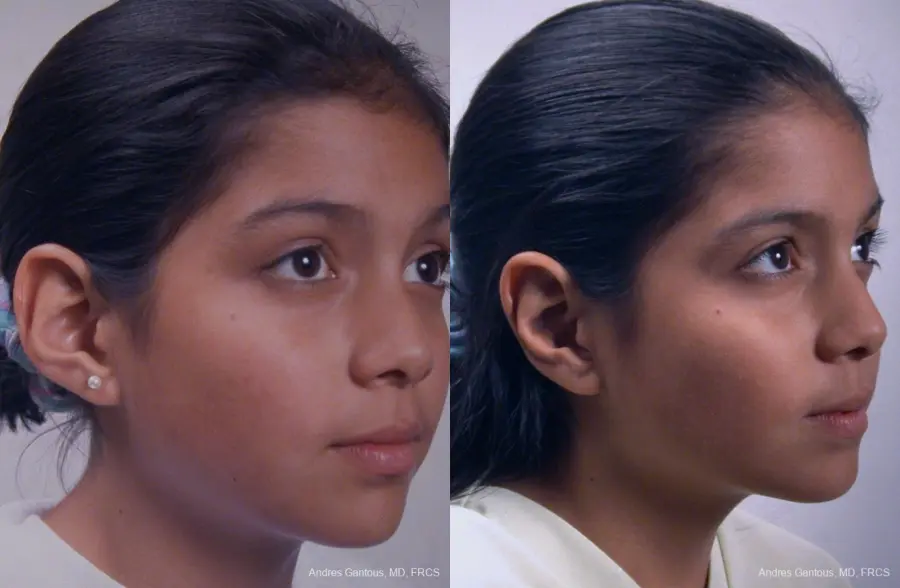 Otoplasty And Earlobe Repair: Patient 25 - Before and After 2