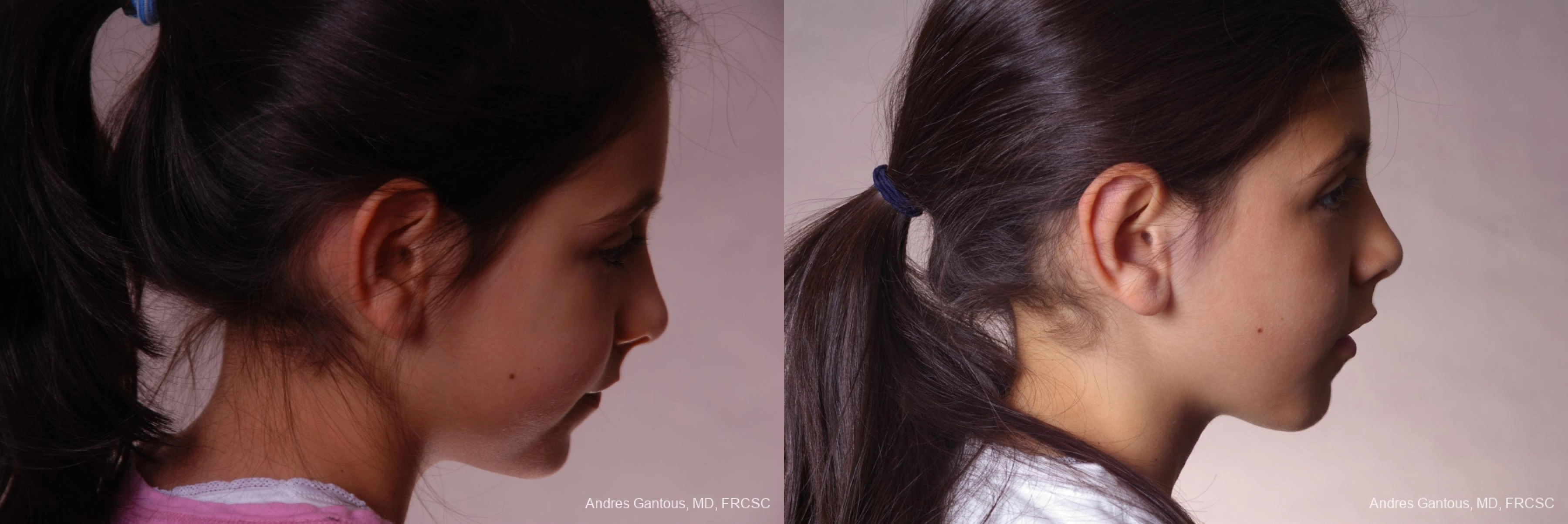 Otoplasty and Earlobe Repair - Thumbnail 3